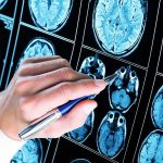 Hidden Damage Haunts NFL Legends Hand with pen pointing at brain MRI scans